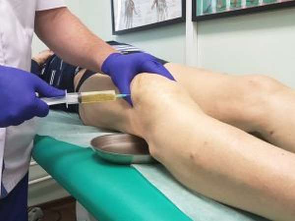 Пункция коленного сустава для извлечения сгустков крови